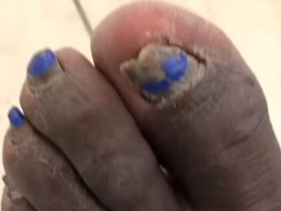 Exídolo del deporte paga $1,000 para que le arreglen sus dañados pies Así lucen los pies de Shaquille O'Neal